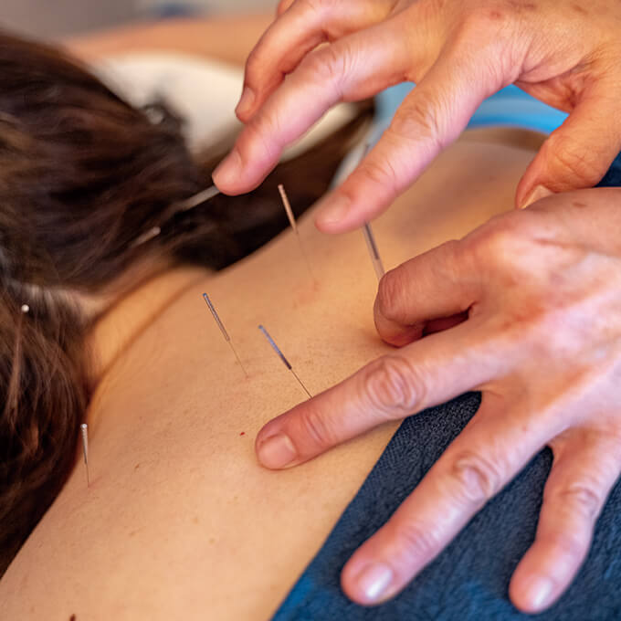 鍼灸